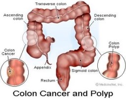 colon-cancer-thumb