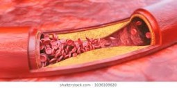 Arterial Damage