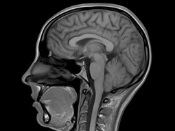 MRI image of brain