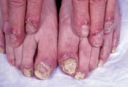 Reactive Arthritis symptoms - feet & hands (dermatology advisor)