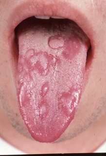 Reactive Arthritis Tongue (Dermatology Advisor)